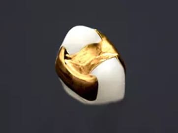 ゴールドインレー(大臼歯。隣接面含む)