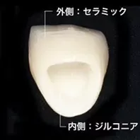 ジルコニア