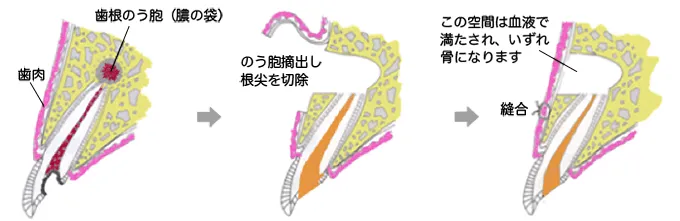 歯根端切除術