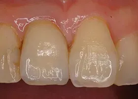 治療後